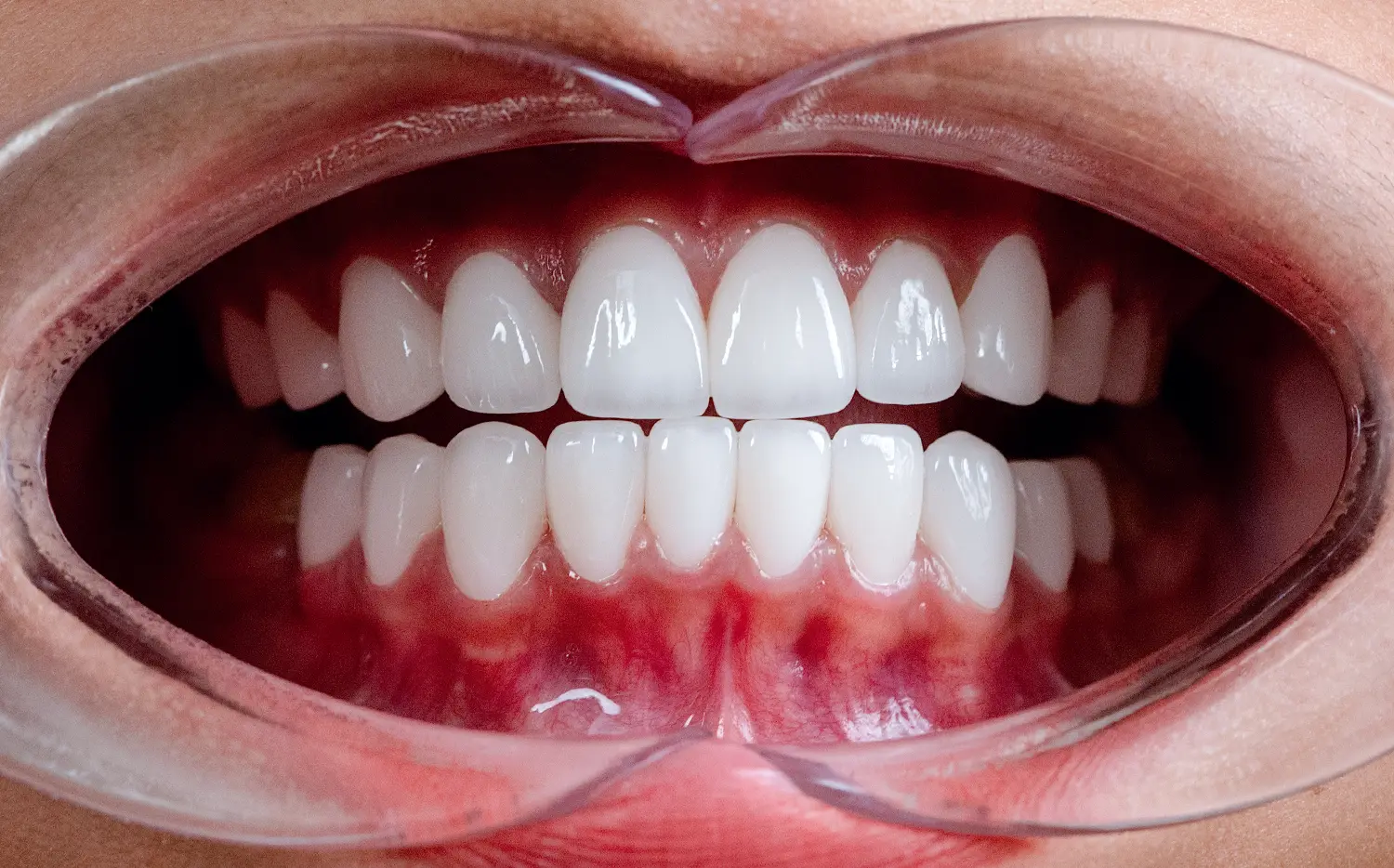 Porcelain Crowns After Case 1