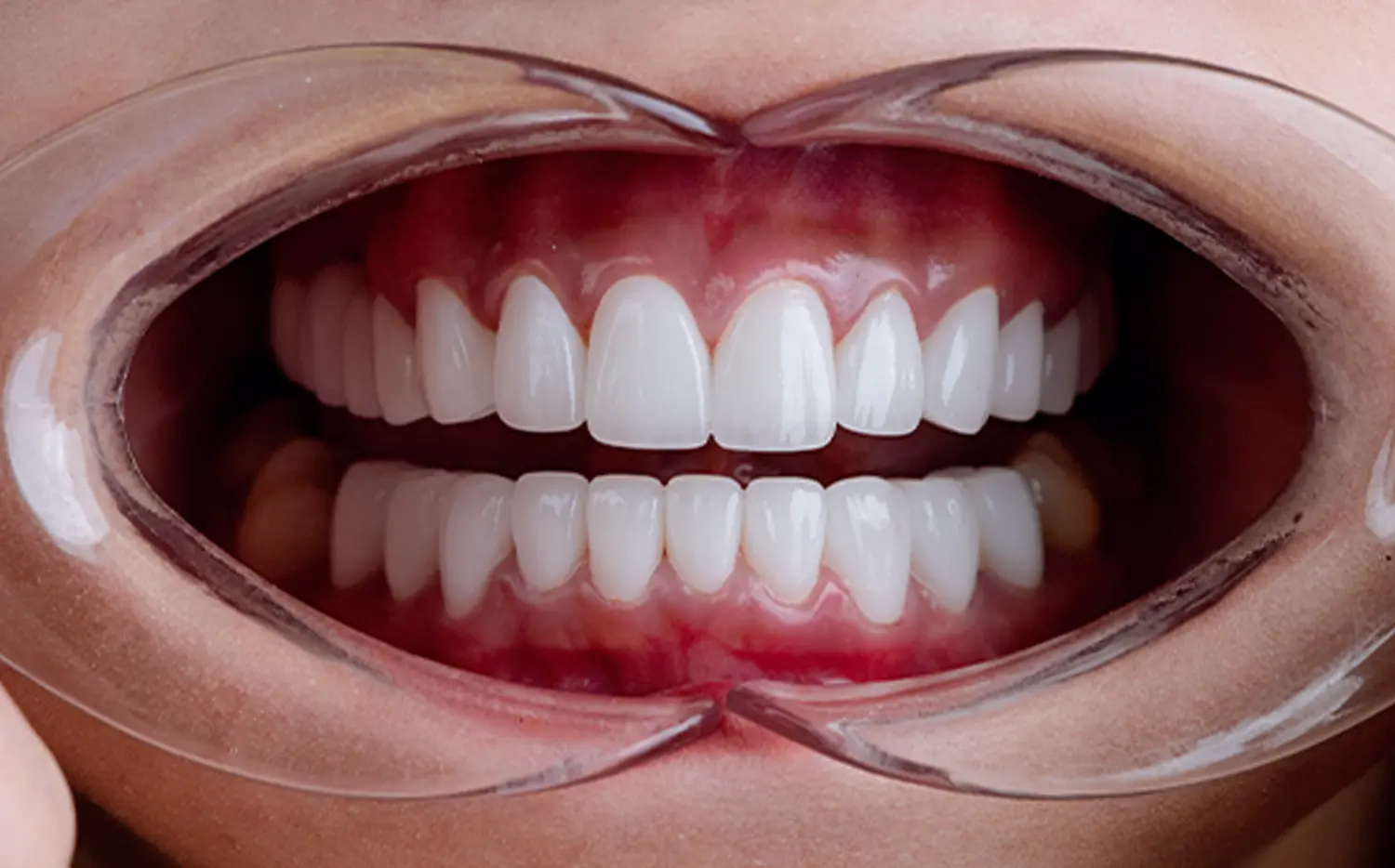 Porcelain Crowns After Case 2