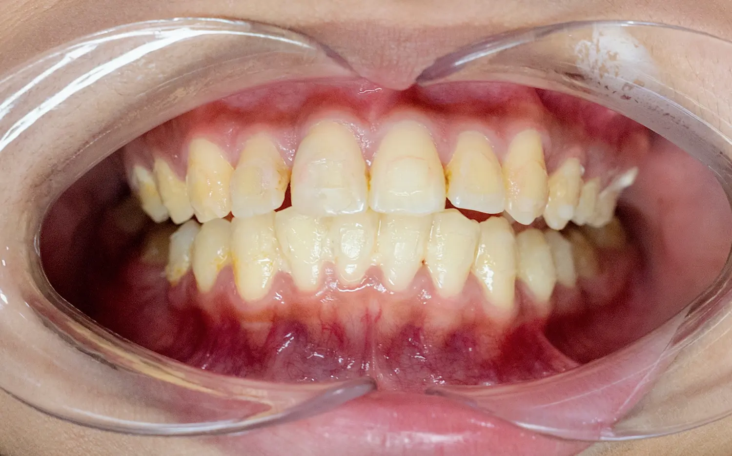 Porcelain Crowns Before Case 1