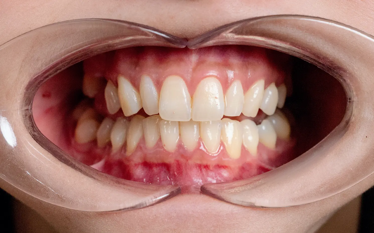 Porcelain Crowns Before Case 2