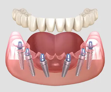 Tooth extraction and placement of 4 to 6 implants per arch