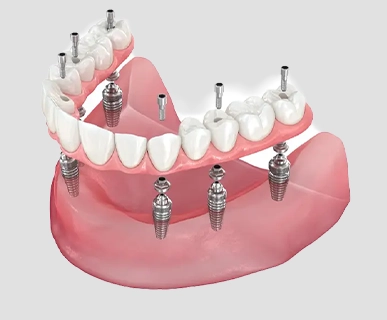 Delivery of a fixed full-arch temporary prosthesis