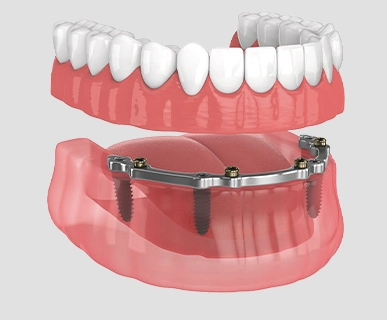 Placement of the final full-arch implant bridge