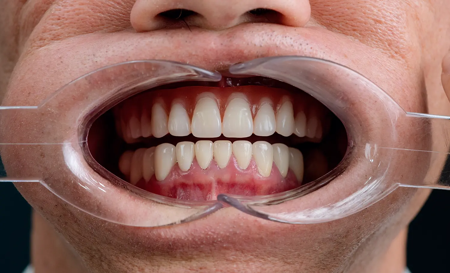 Full Arch Implants After Case 1