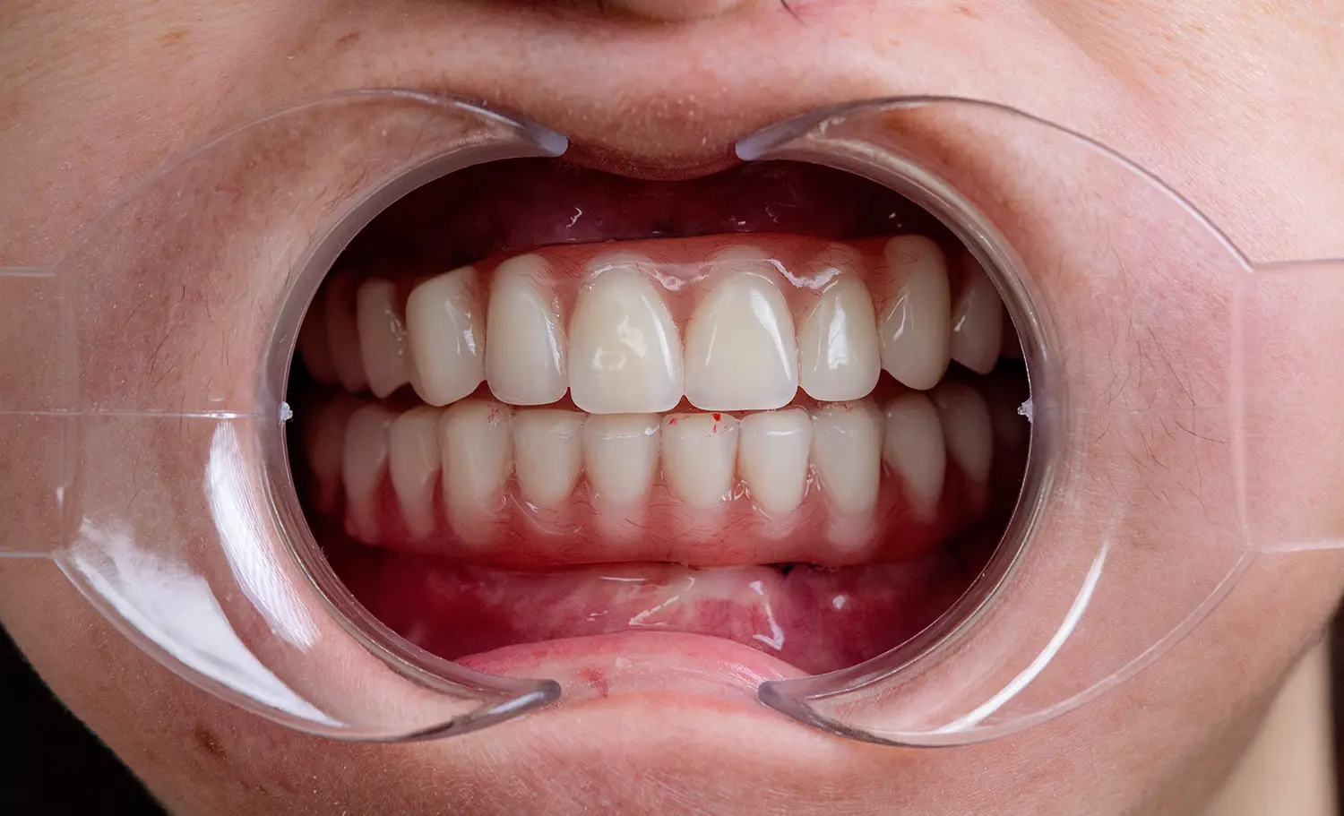Full Arch Implants After Case 2