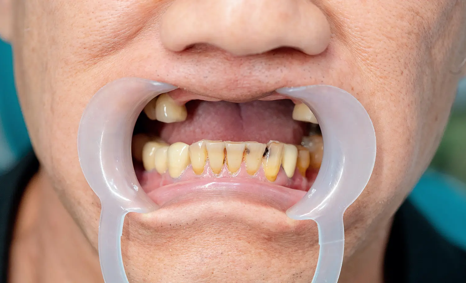 Full Arch Implants Before Case 1
