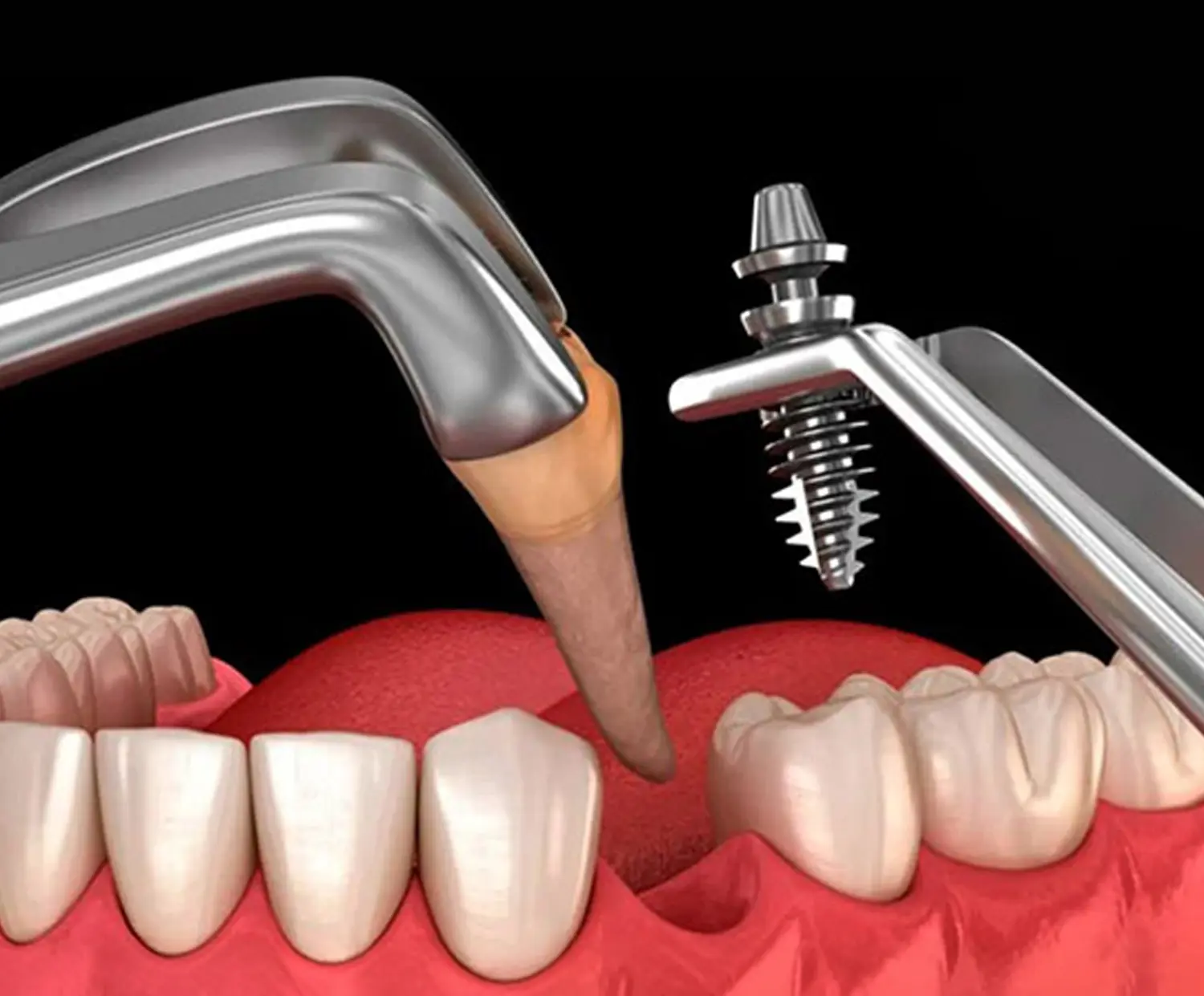 Tooth extraction and immediate implant placement