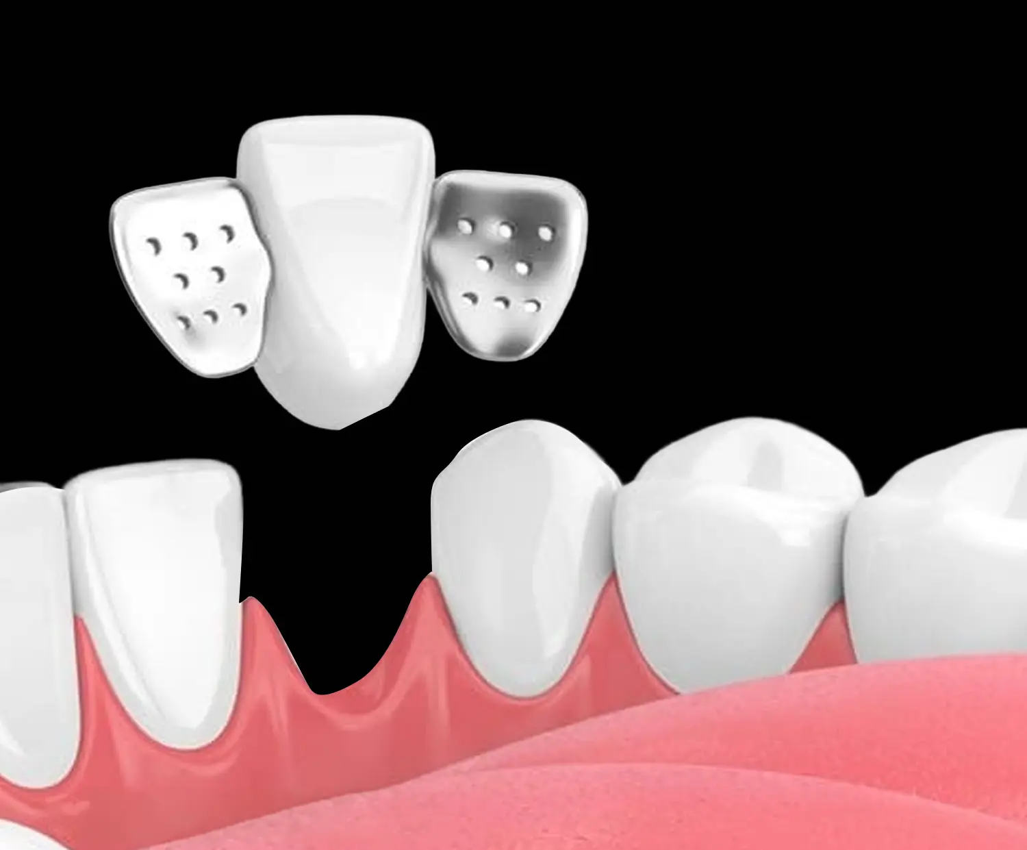 Attachment of temporary tooth