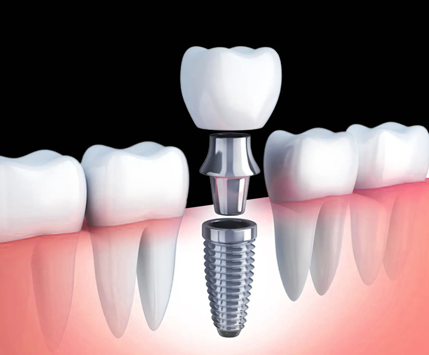 Placement of permanent crown