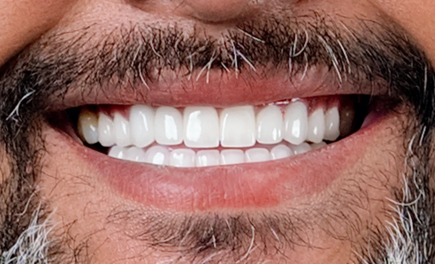 Immediate Implants After Case 1