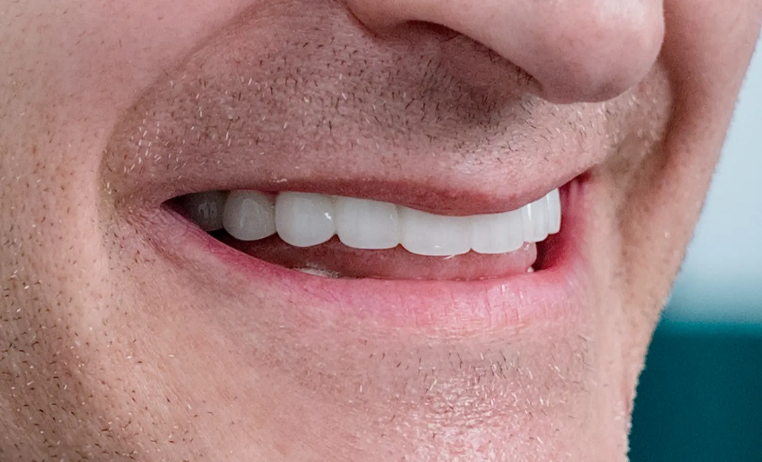 Immediate Implants After Case 2