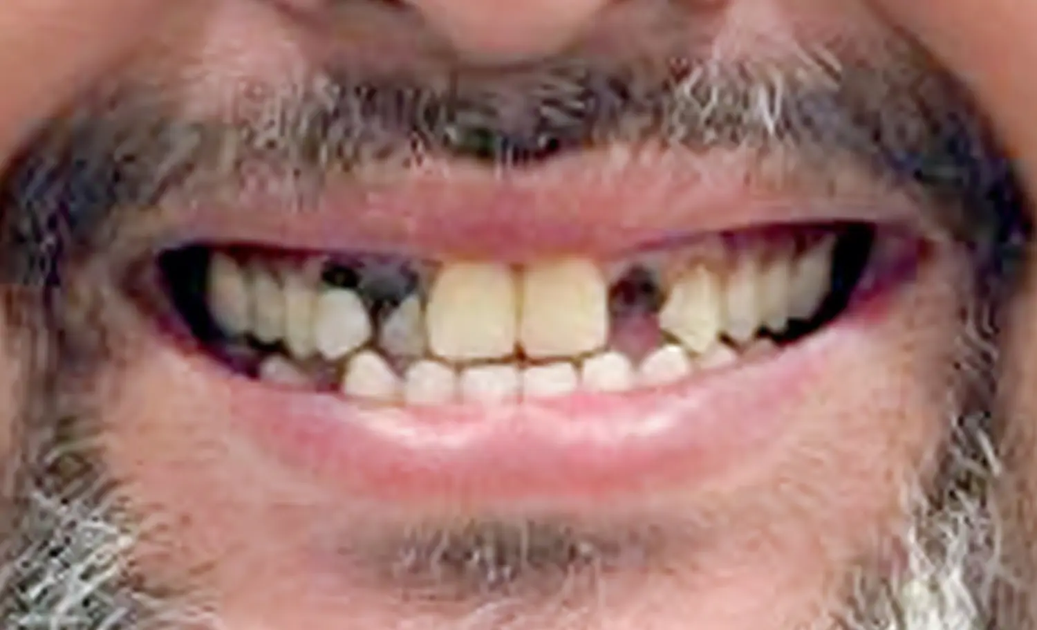 Immediate Implants Before Case 1