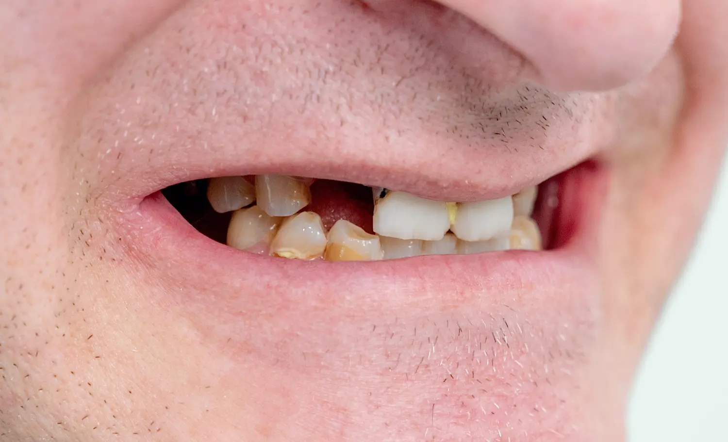 Immediate Implants Before Case 2