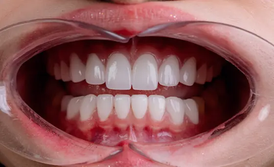 Porcelain Veneers After Case 1