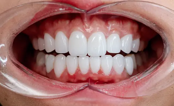Porcelain Veneers After Case 2