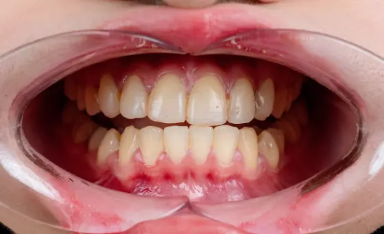 Porcelain Veneers Before Case 1