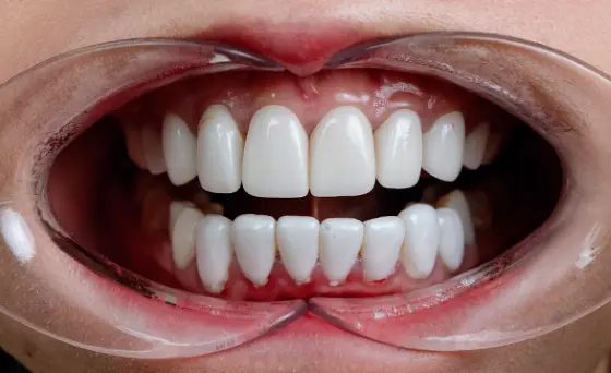 Porcelain Veneers Before Case 2