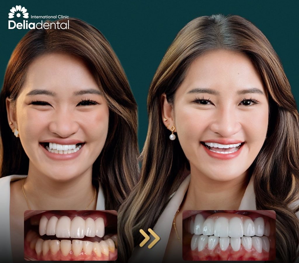 Dental Implants: The Most Advanced Solution for Missing Teeth