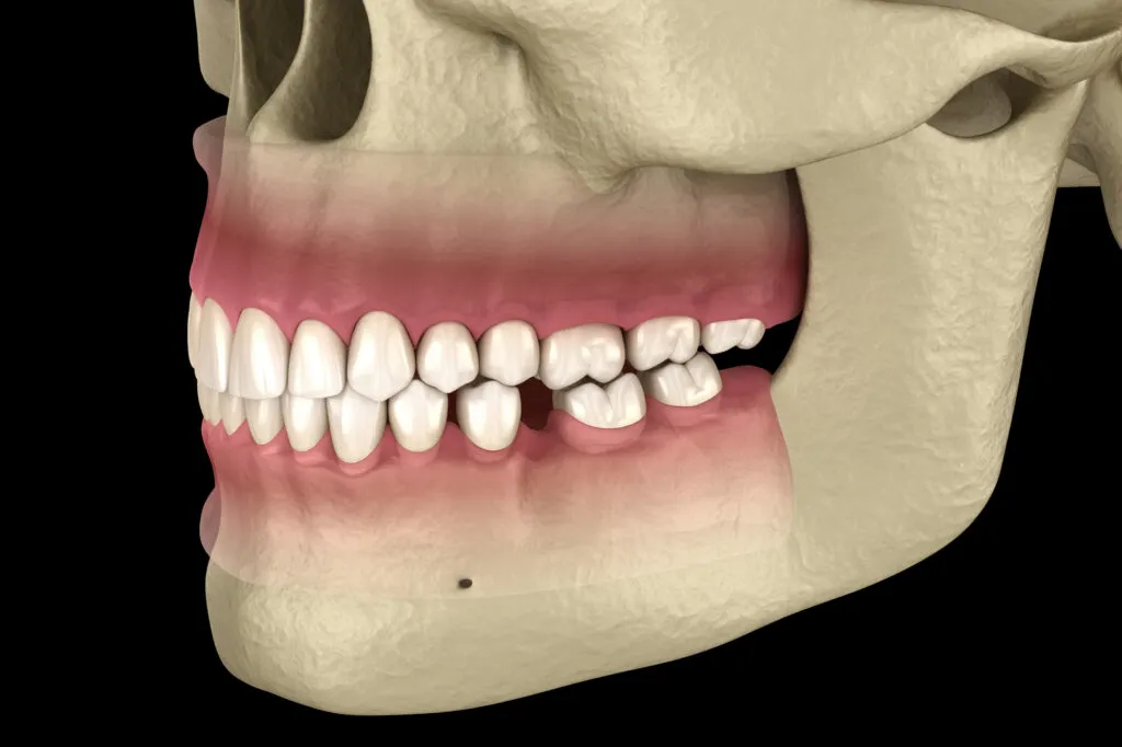 3D illustration showing bone loss in the jawbone after tooth loss, explaining why dental implants are needed