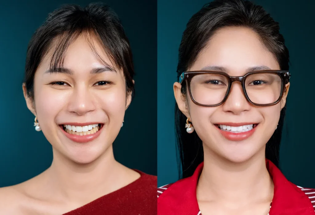 Rean's amazing veneers result at Delia Dental Clinic