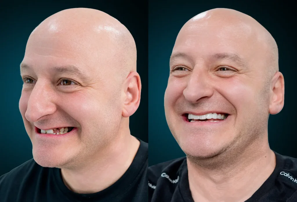 Full mouth dental implants before and after at Delia Dental Clinic