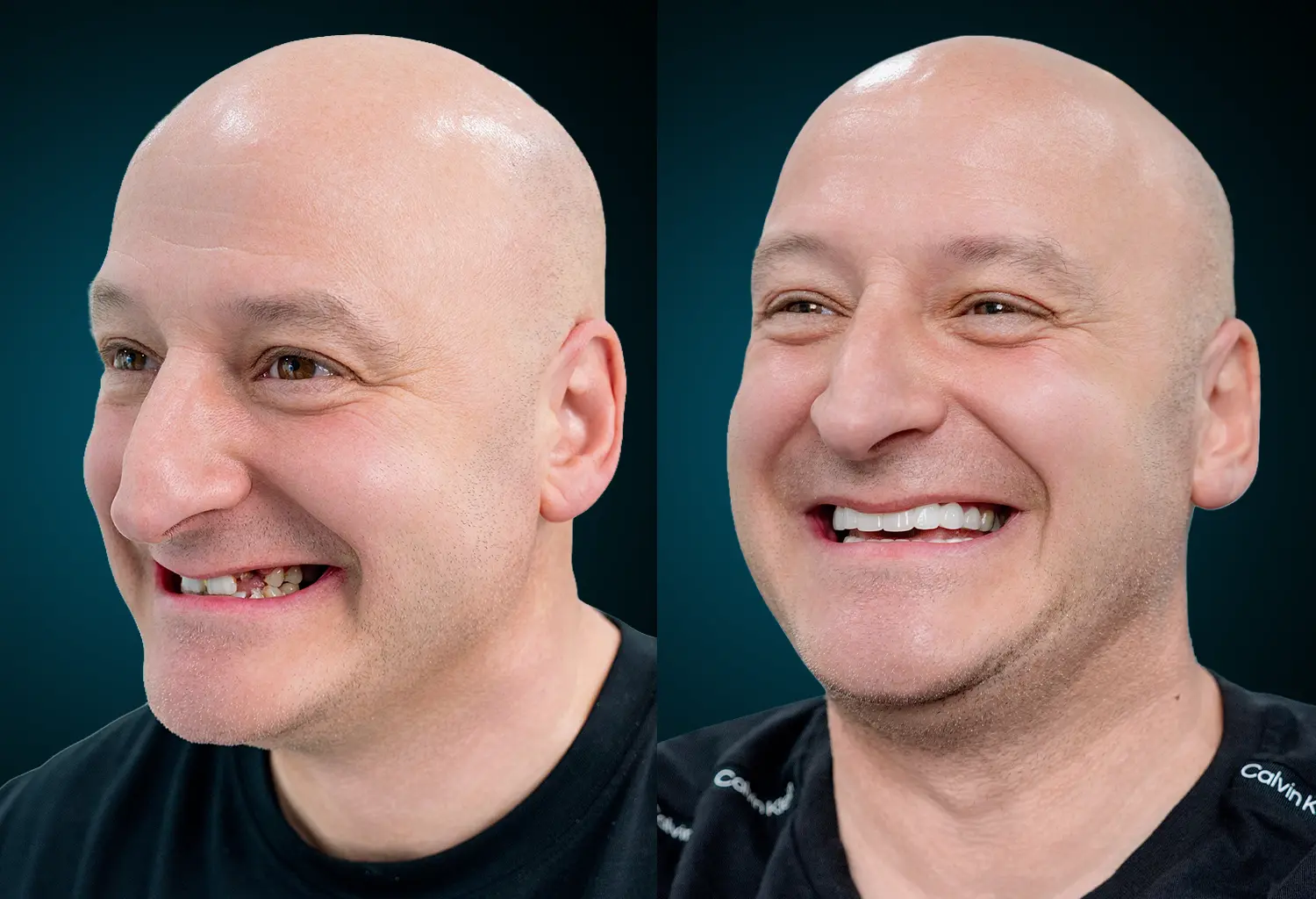 Delia Dental Review - Eliseo – Full Smile Restoration with 6 Implants