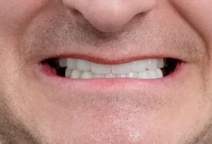 Healthy and stable smile results after 6 dental implants restoration for Eliseo