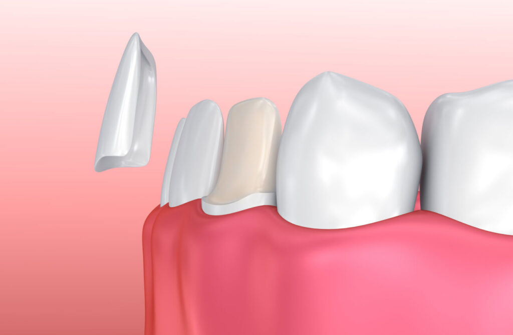 3D illustration showing how ultra-thin dental veneers are bonded to the front surface of teeth