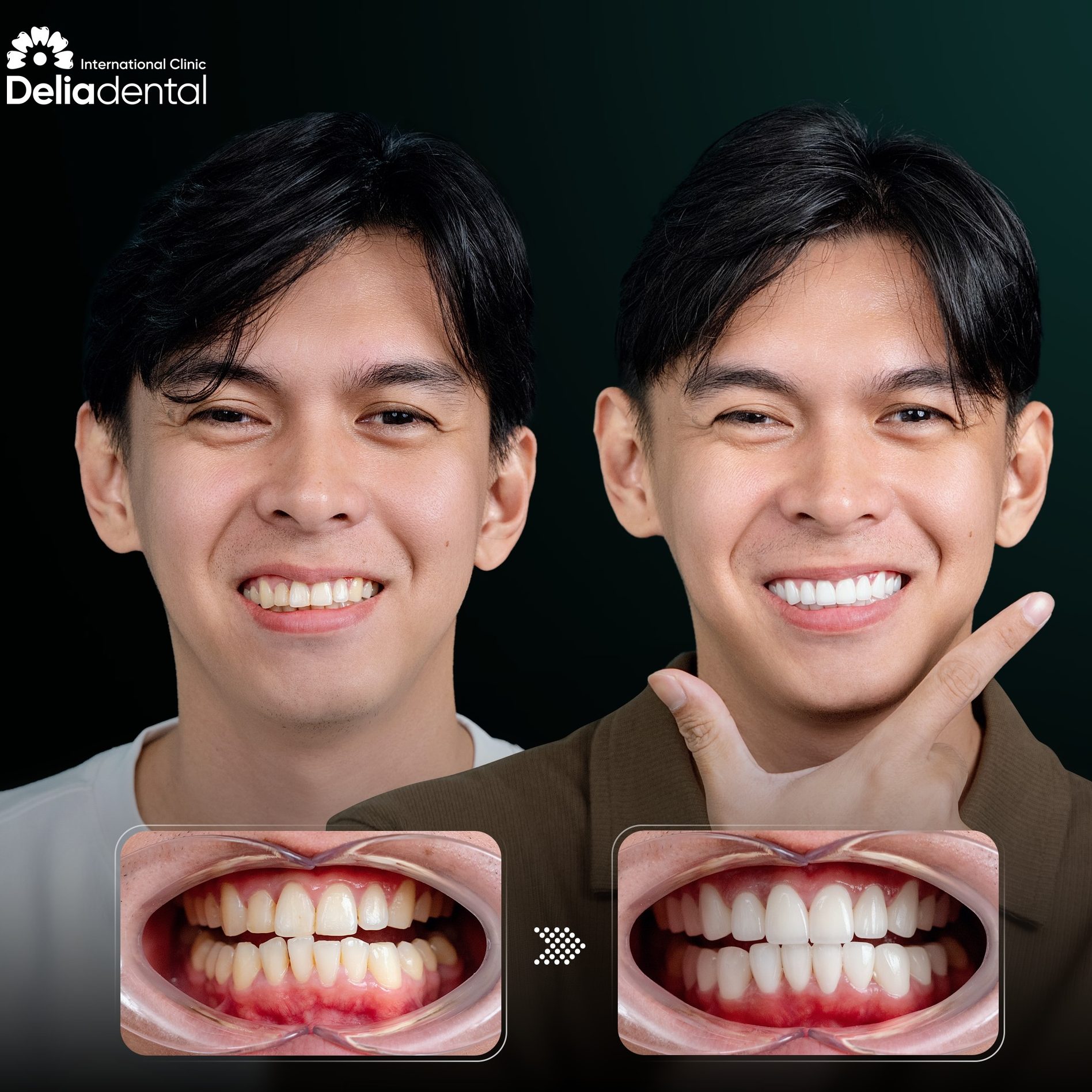 Dental veneer smile makeover in Vietnam