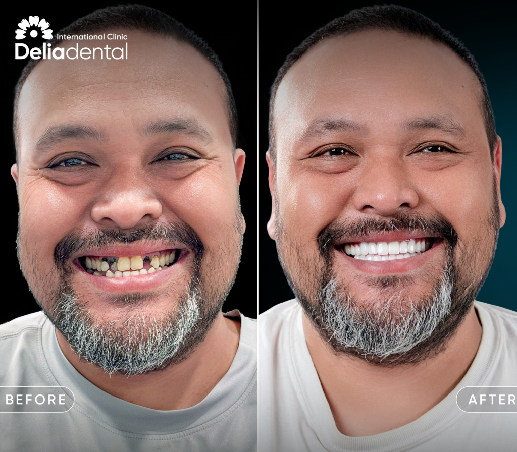 Amazing result doing implants at Delia Dental Clinic