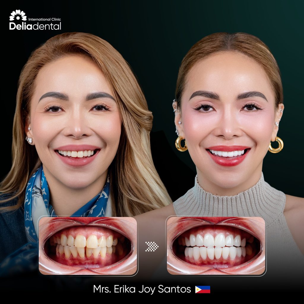 Before after smile makeover in Vietnam