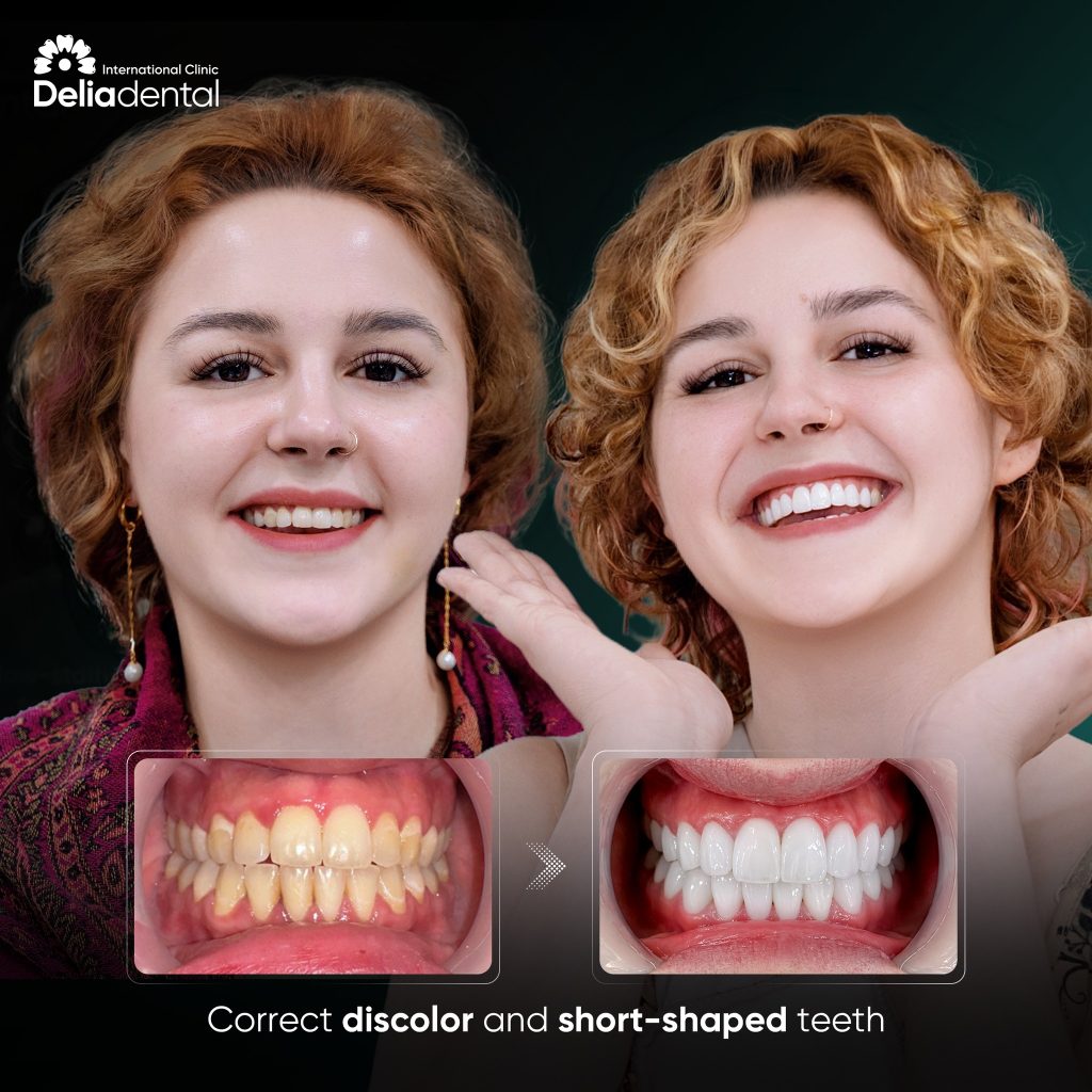 Before and after smile makeover