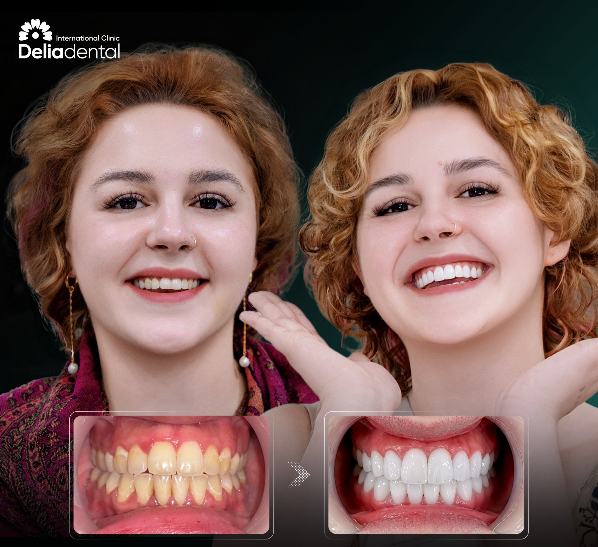 How to Get Natural-Looking Porcelain Crowns in Vietnam