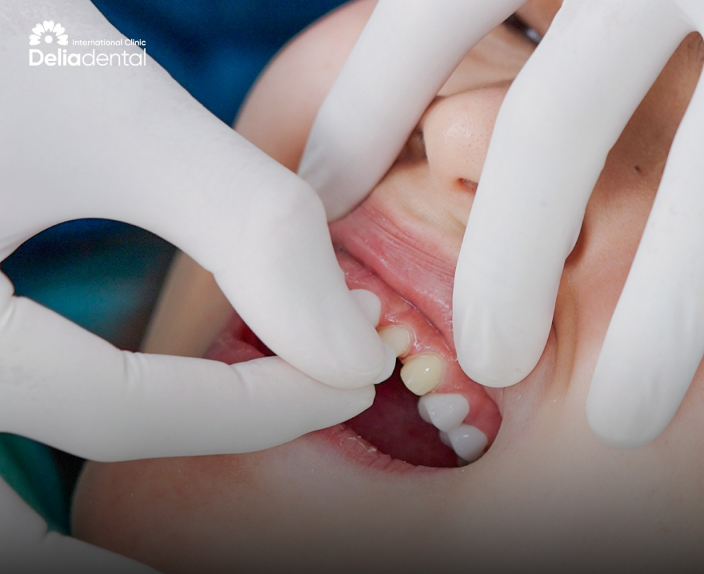What Affects Dental Crown Cost in Vietnam?