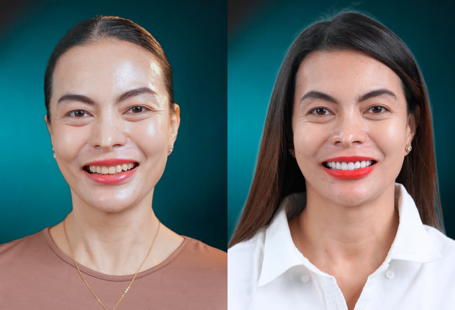 Delia Dental Review - Ayhan David – 18 Porcelain Crowns for a Bright Smile