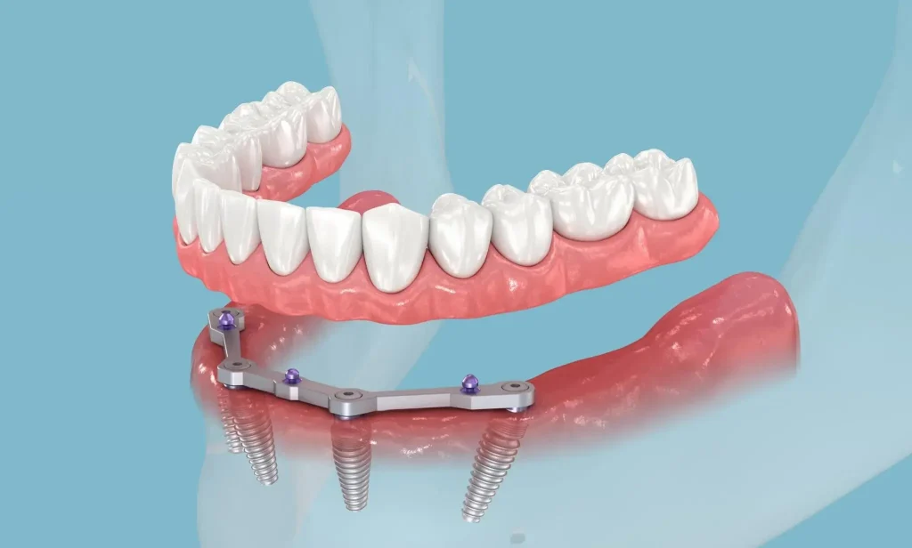 All-on-4 Dental Implants Vietnam: What Australians Need to Know