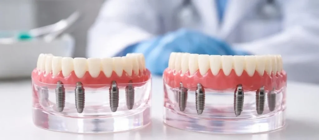 All-on-4 vs All-on-6 Dental Implants in Vietnam: Which Is Right for You?