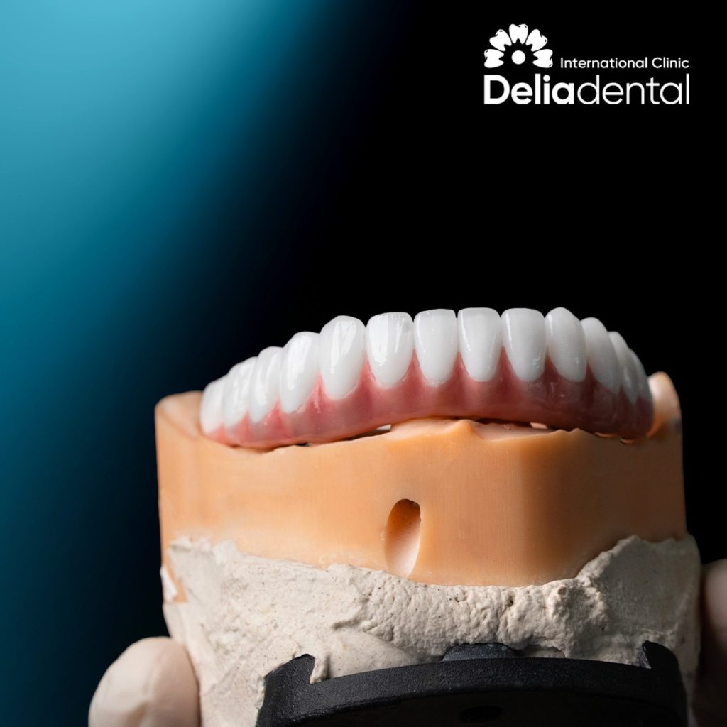 Full arch dental implants at Delia Dental Clinic