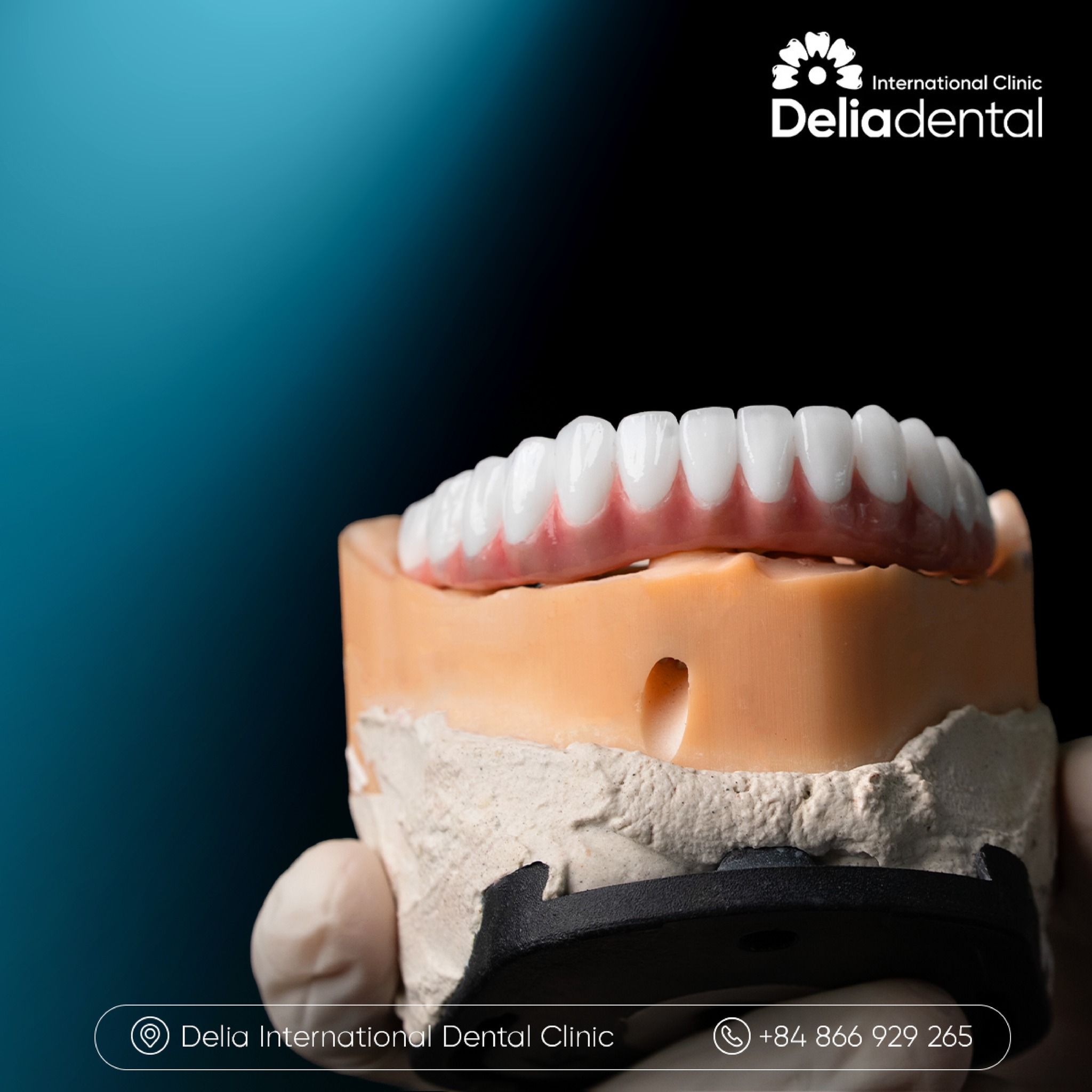 What Is the Cost of All-on-6 Dental Implants in Vietnam?