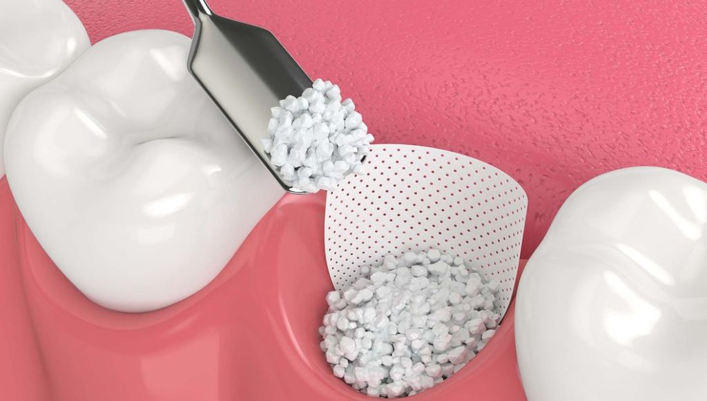 Why bone grafting in Vietnam is a smart investment for your smile