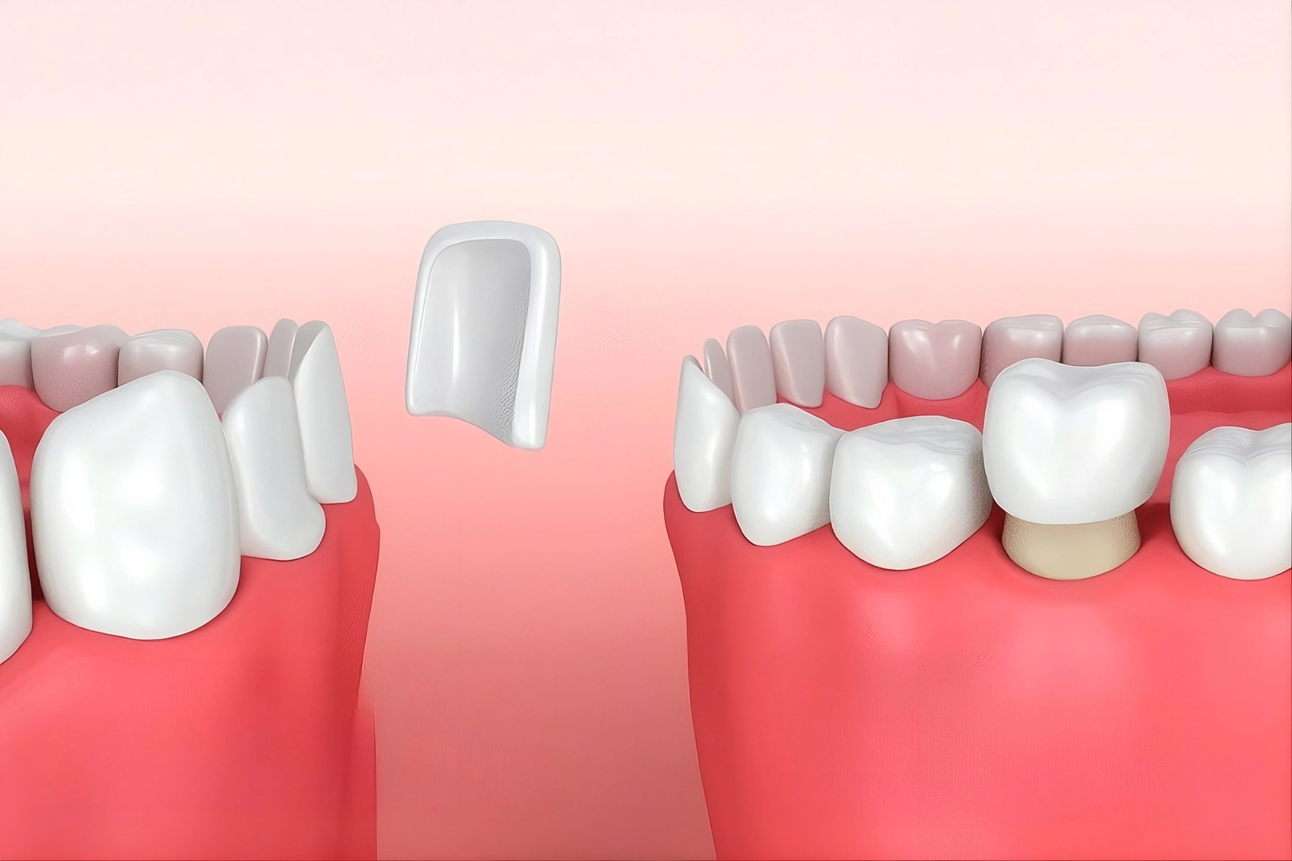 Dental Veneers vs Dental Crowns: Which is Right For You?