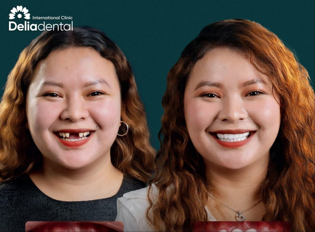 How Many Dental Implants Do You Need for a Full Smile?