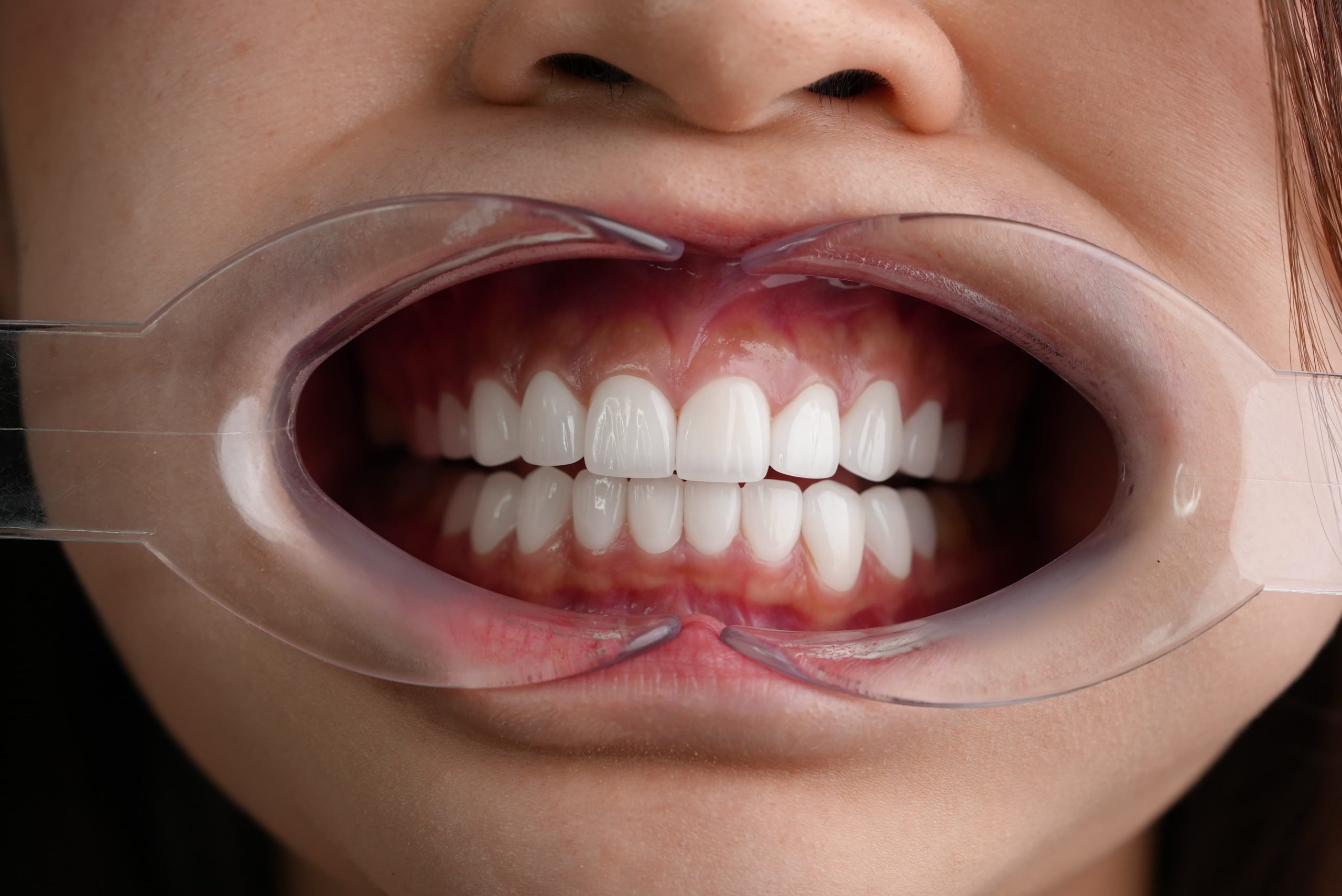 What Is an E.max Dental Crown and Is It Worth It?