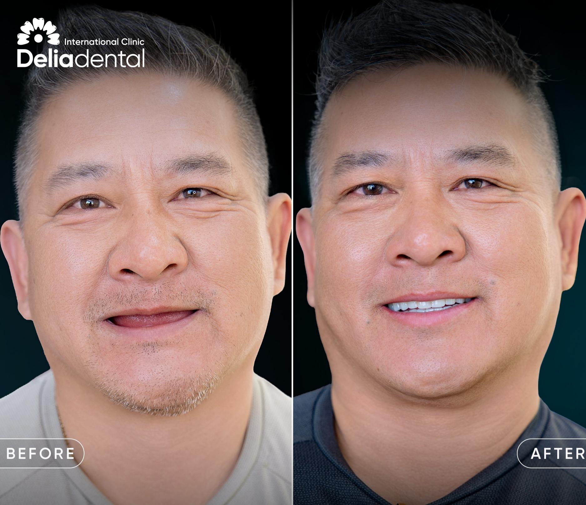 Full Arch Dental Implants Vietnam: Temporary vs Final Teeth