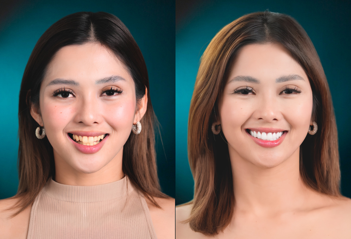 Delia Dental Review - Jay Santiago – Implants & Crowns Experience at the Best Dental Clinic in Vietnam