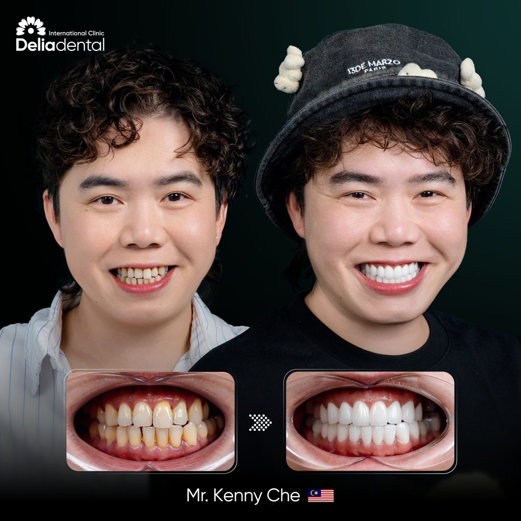 Mr. Kenny amazing Zirconia Crowns at premium dentistry in Vietnam