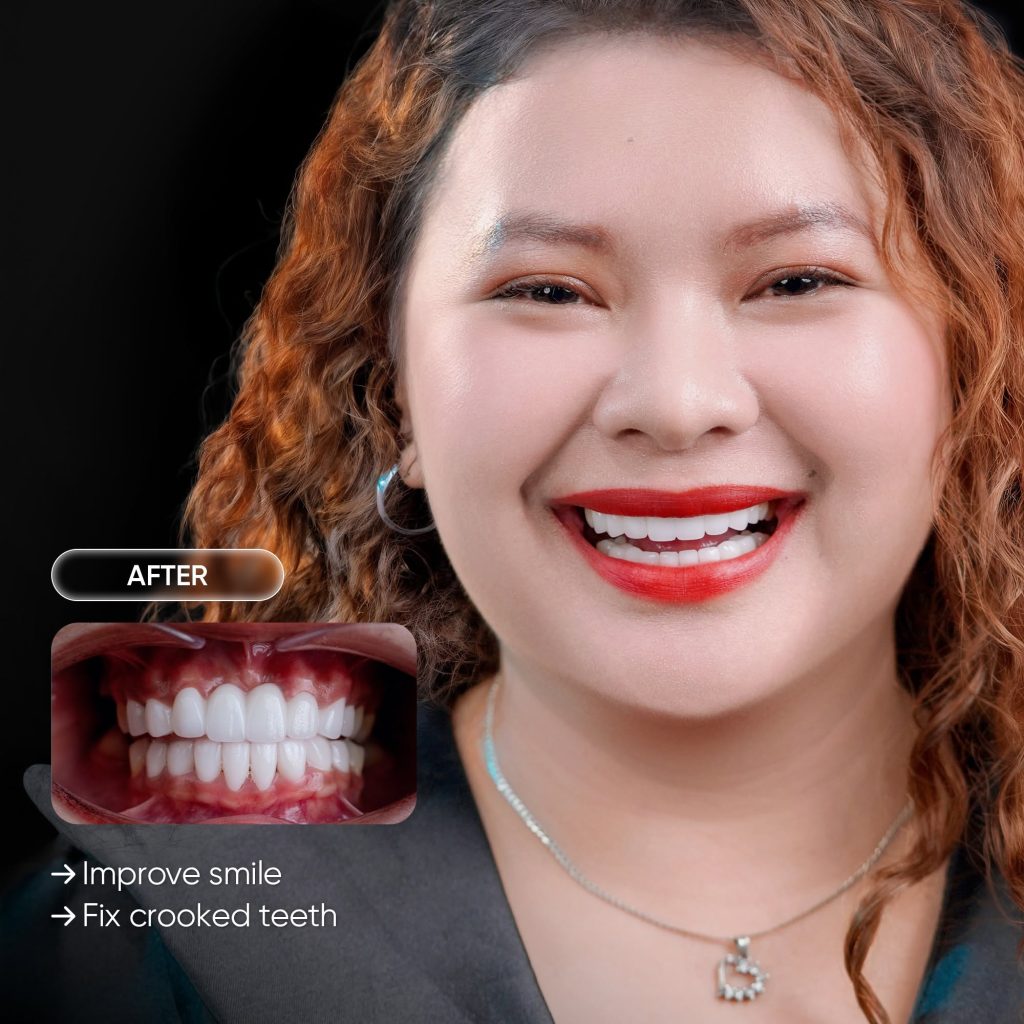 Shira Econar amazing result at Delia Dental Clinic