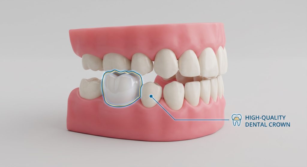 Why Can a New Dental Crown Feel Too High After Fitting?