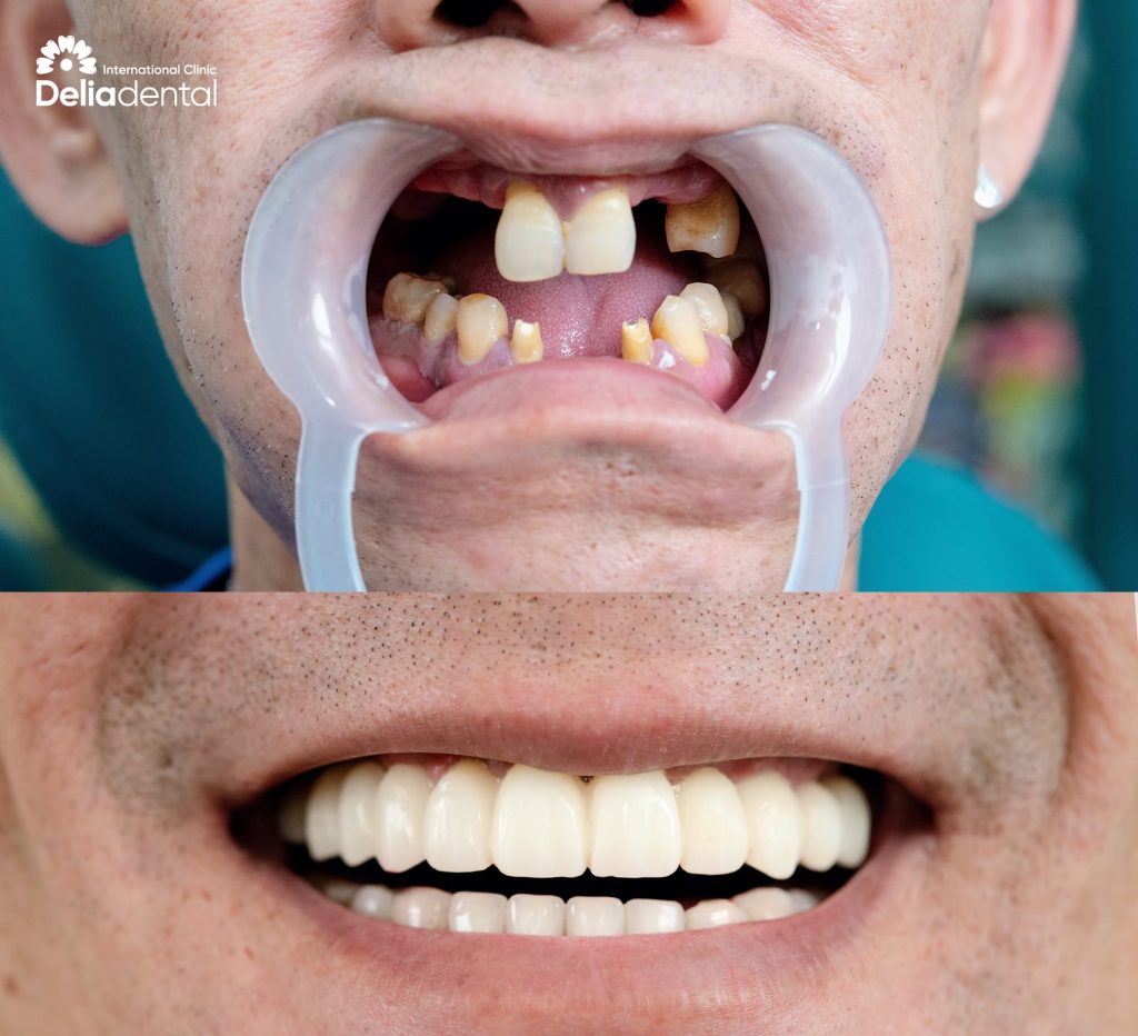 Dental Implant before and after at Delia Dental Clinic