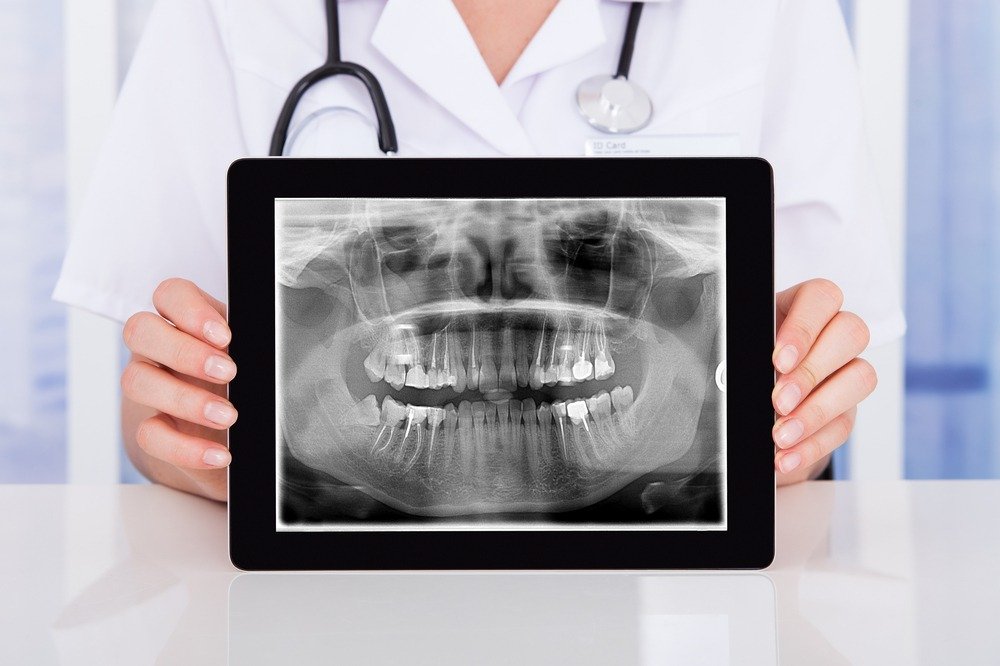 What Can an X-Ray Confirm Before an Implant Trip to Vietnam?